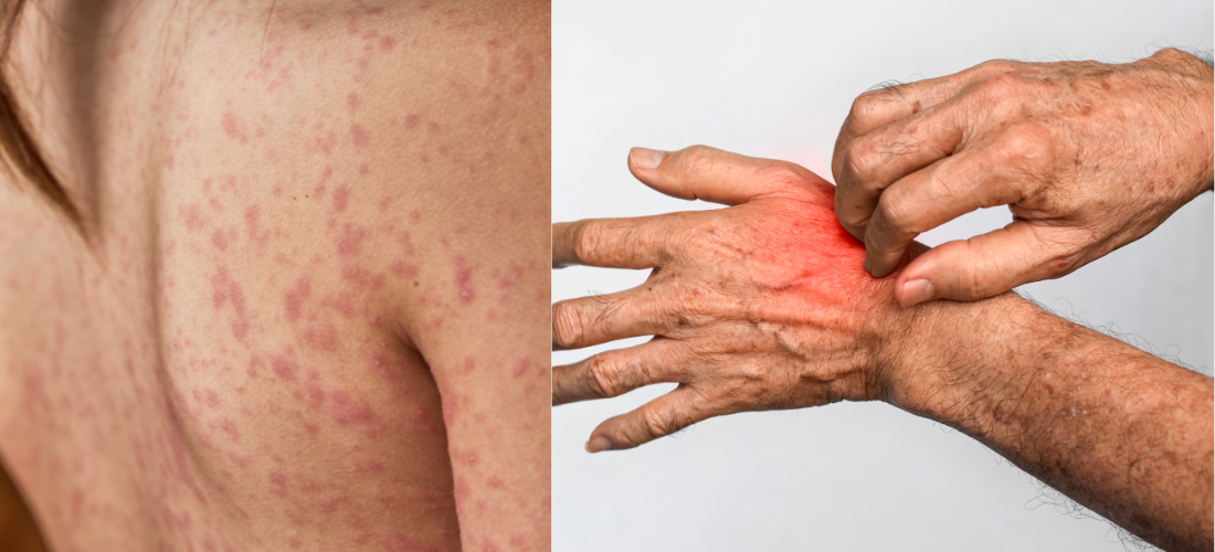 Bacterial Skin Infections Treatment